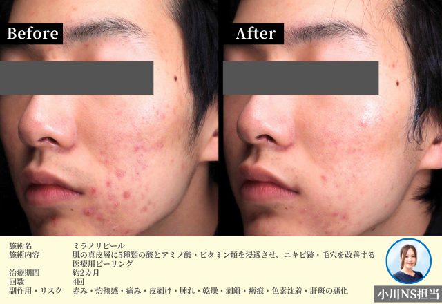 ミラノリピール