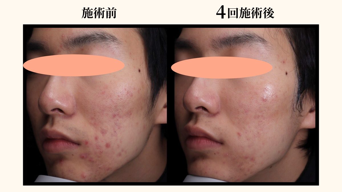 ミラノリピールを行った患者さんのビフォーアフター画像