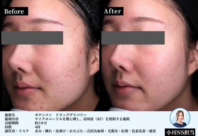 大阪・梅田のお得なポテンツァキャンペーン