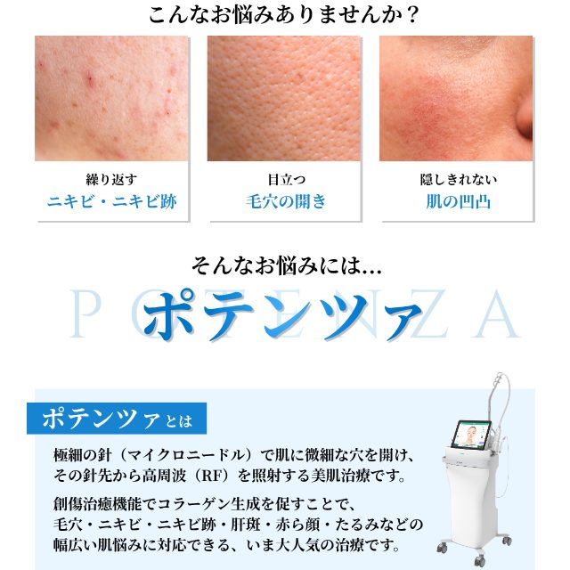 大阪・梅田のお得なポテンツァキャンペーン